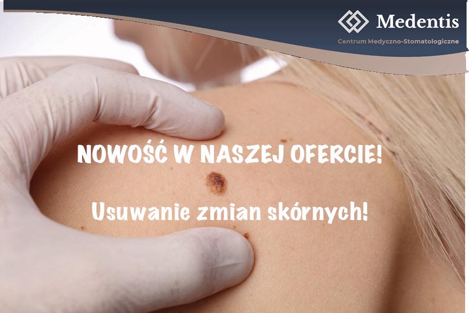 Usuwanie znamion Tomaszów Mazowiecki